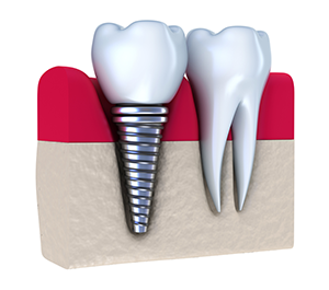 Dental Implants | | Dentist in Worcester, MA | Dentistry by Dr. Nita Gampa